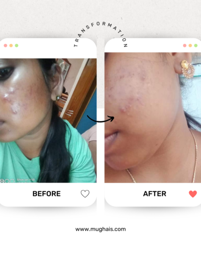 Before After Acne Kit